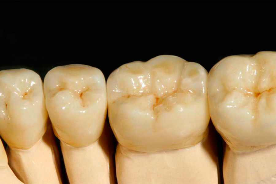 Z Crown Dental Layered Zirconia Ceramil® Image