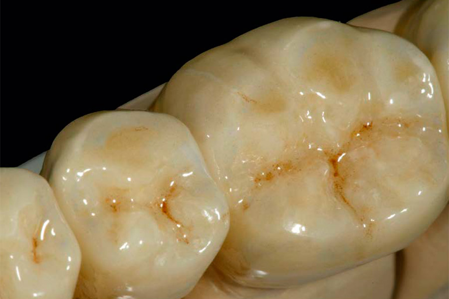 Z Crown Dental Layered Zirconia Ceramil® Image